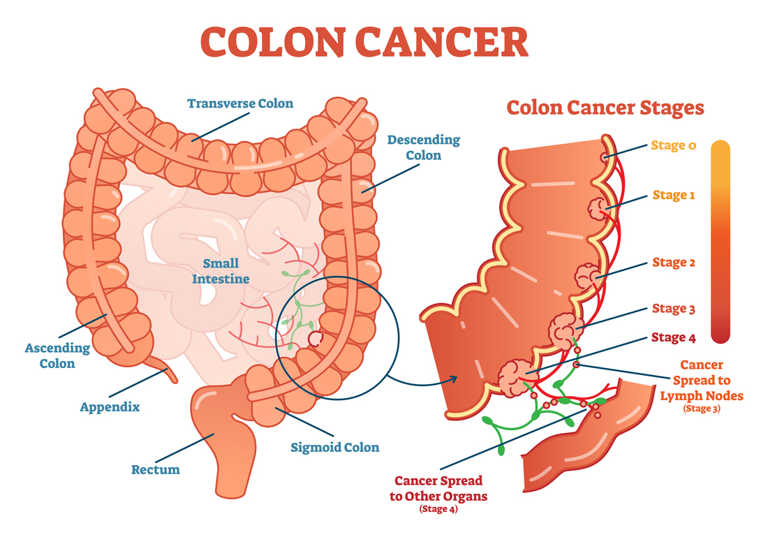 Colon Cancer Stages